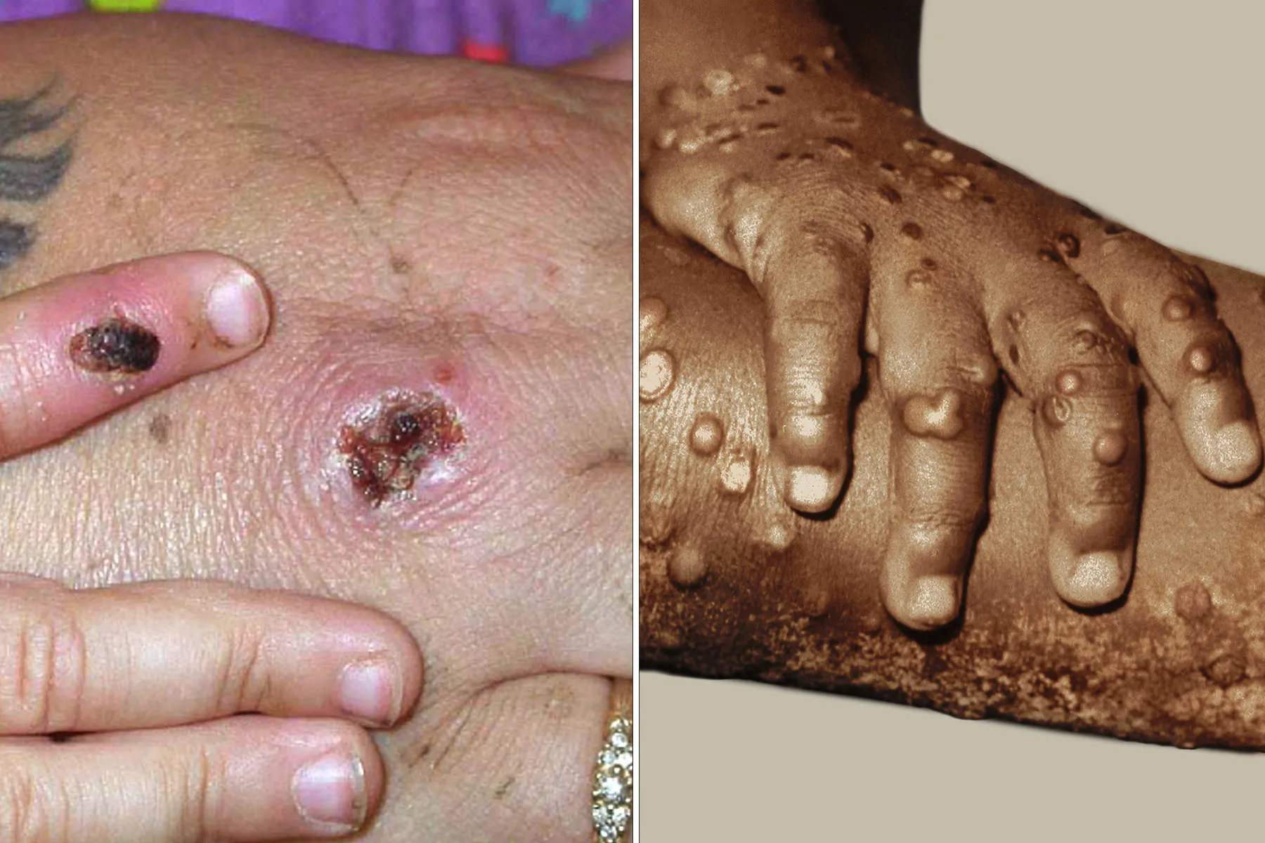 Global Monkeypox Cases Rise to More Than 550 thumbnail
