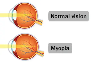 myopia vision vs normal vision
