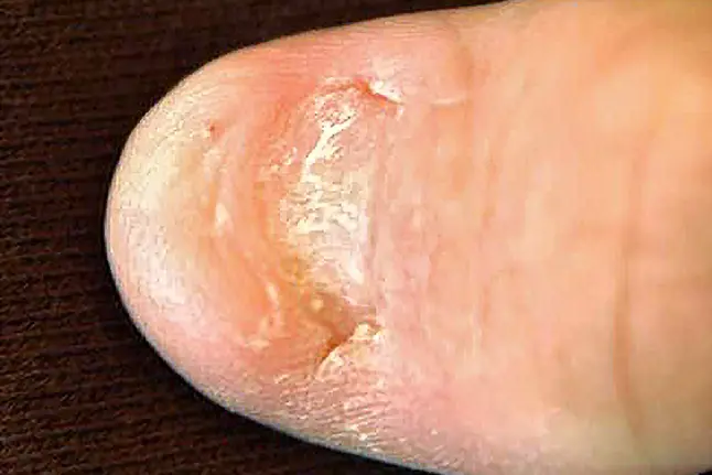 photo of nail-patella syndrome
