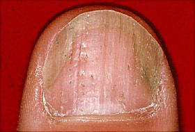 Dents in fingernails tiny Do Dents