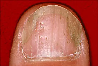 nail psoriasis