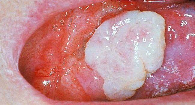 hpv on tongue treatment