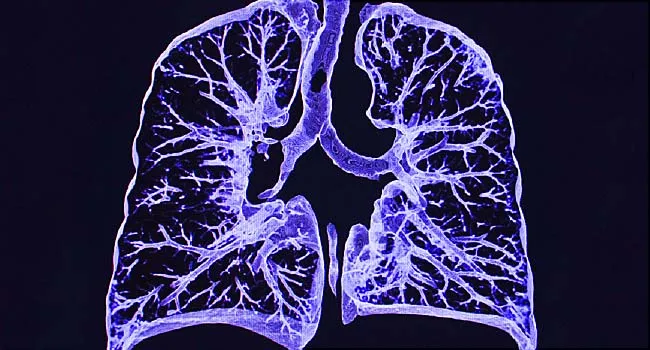 ct scan of lungs