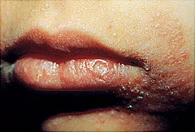 perioral dermatitis