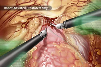 photo of robotic prostatectomy