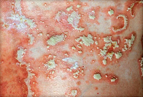 a lábán egy piros folt jelent meg pikkelysmr pikkelyes lichen hogyan kell kezelni