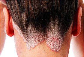 psoriasis behind ears and neck