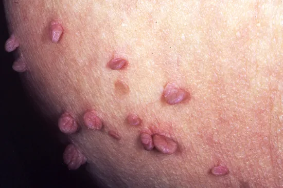 photo of skin tags