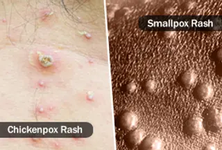smallpox vs chickenpox