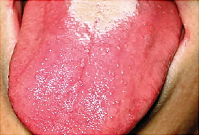 25 Disgusting Tongues and Medical Conditions Behind It I Stay at Home Mum