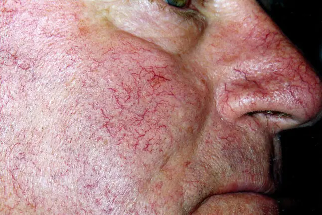 photo of telangiectasias on man's face