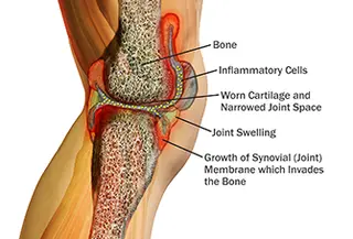 inflamed knee joint anatomy