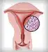 uterus and inlay of fibroids