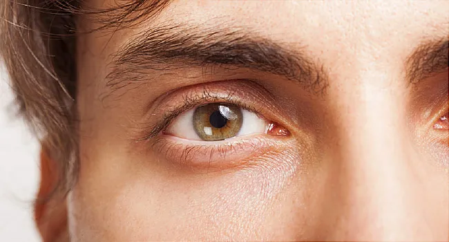 what do eye allergies look like