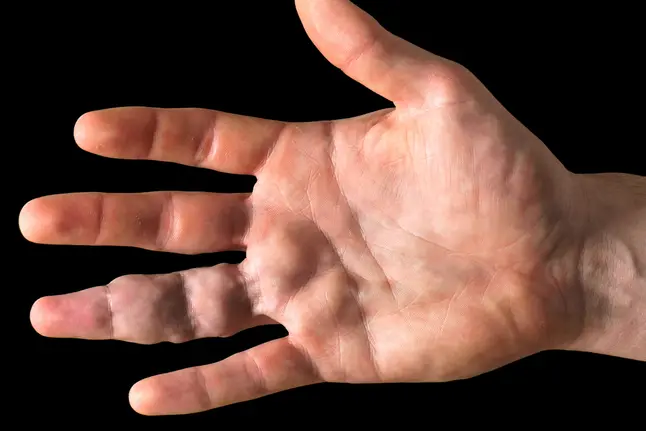 photo of  vascular malformations on hand