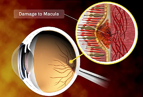 Chart To Check For Macular Degeneration