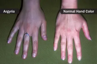 argyria vs normal hand color