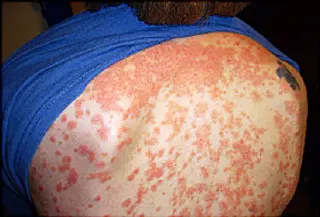 guttate psoriasis rash on back