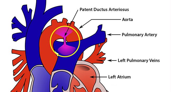 Patent Ductus Arteriosus Pda Symptoms Treatment