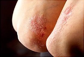 does psoriasis hurt to touch)