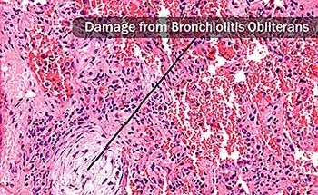 damage from bronchiolitis obliterans