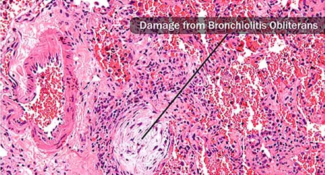 damage from bronchiolitis obliterans