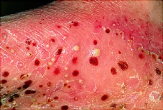 pustular psoriasis close up