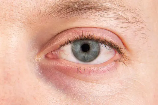 photo of dry eye close up