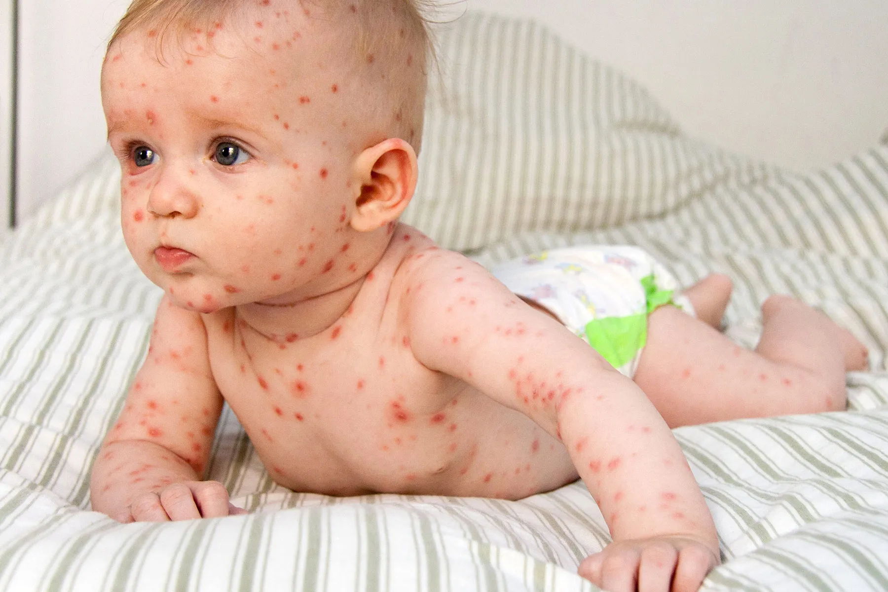 Pictures of Viral Rashes in Adults & Children