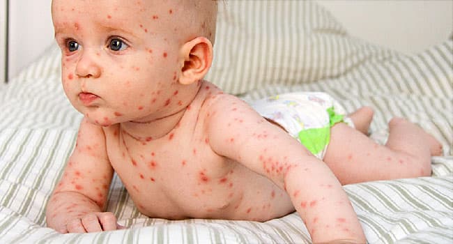 baby with chickenpox