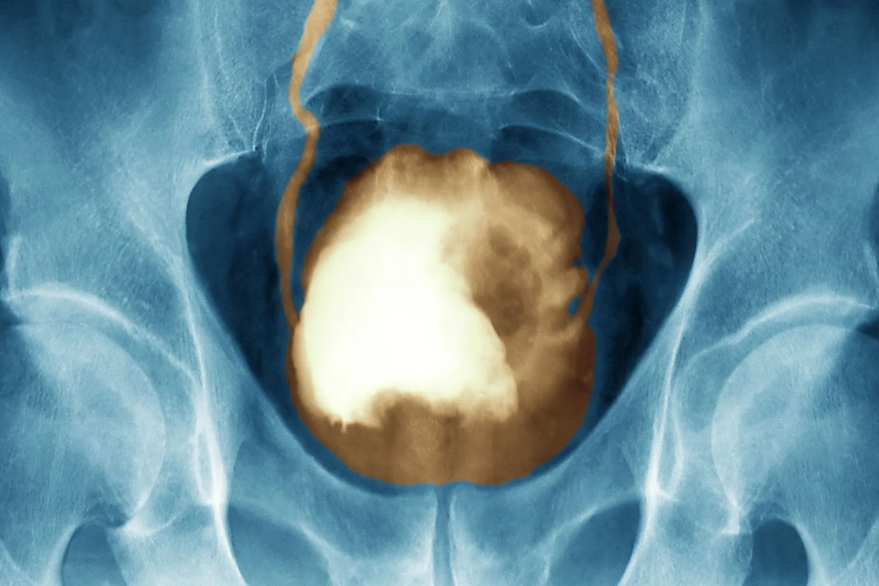 what causes low grade serous ovarian cancer