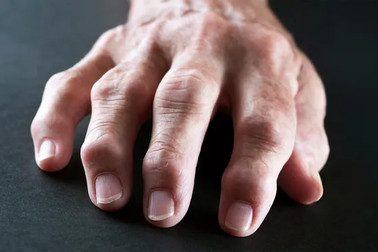 photo of hand displaying rheumatoid arthritis