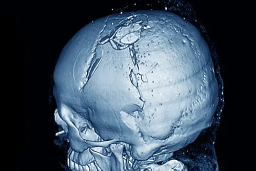 3d scan of fractured skull