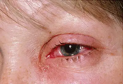 adult pink eye
