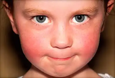 child with red cheeks
