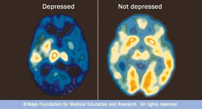 Depressionsübersicht: Emotionale Symptome, körperliche Anzeichen und mehr