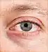 dry eye syndrome close up