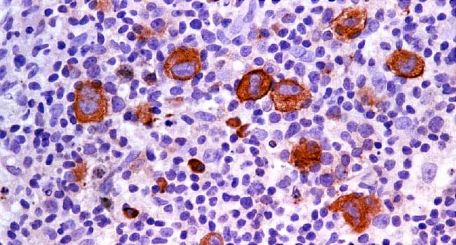 hodgkins lymphoma cells