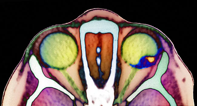 Visual Guide To Eye Cancers 