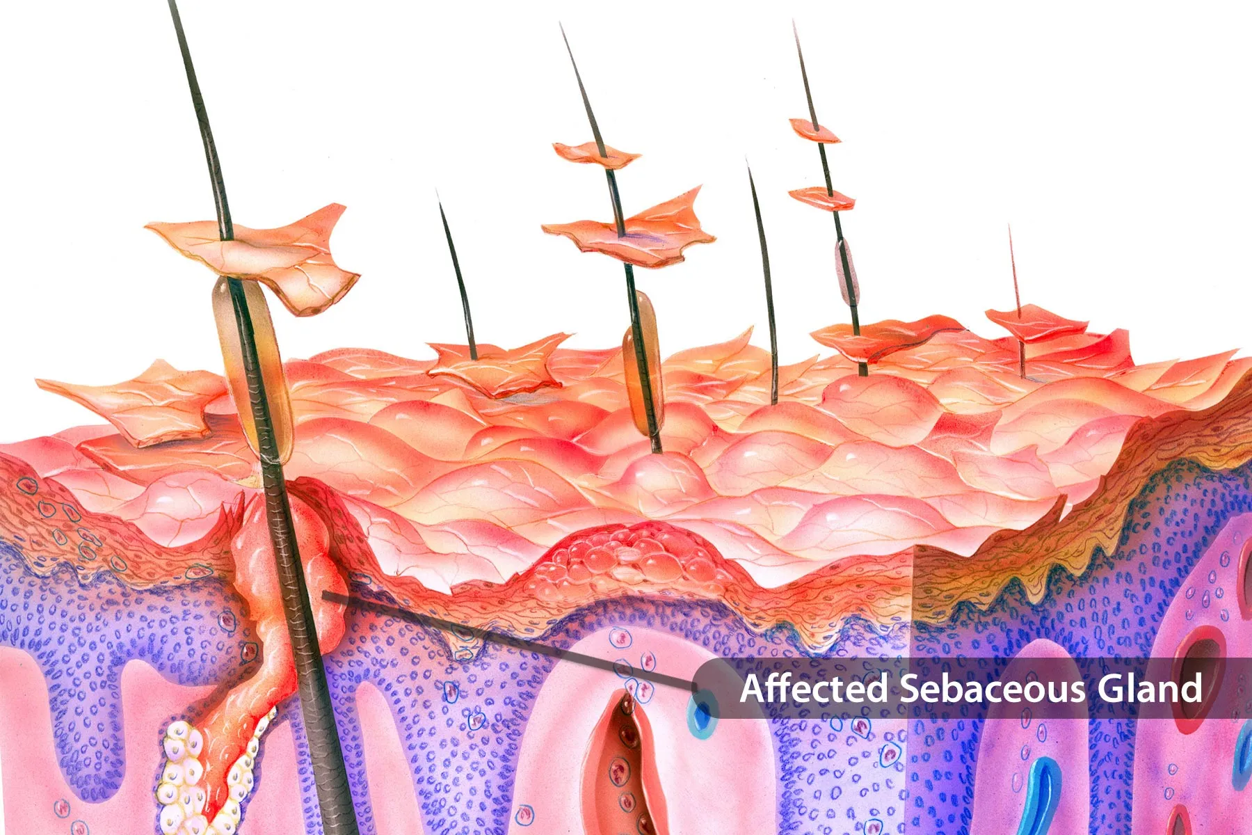 In Pictures Guide to Seborrheic Dermatitis