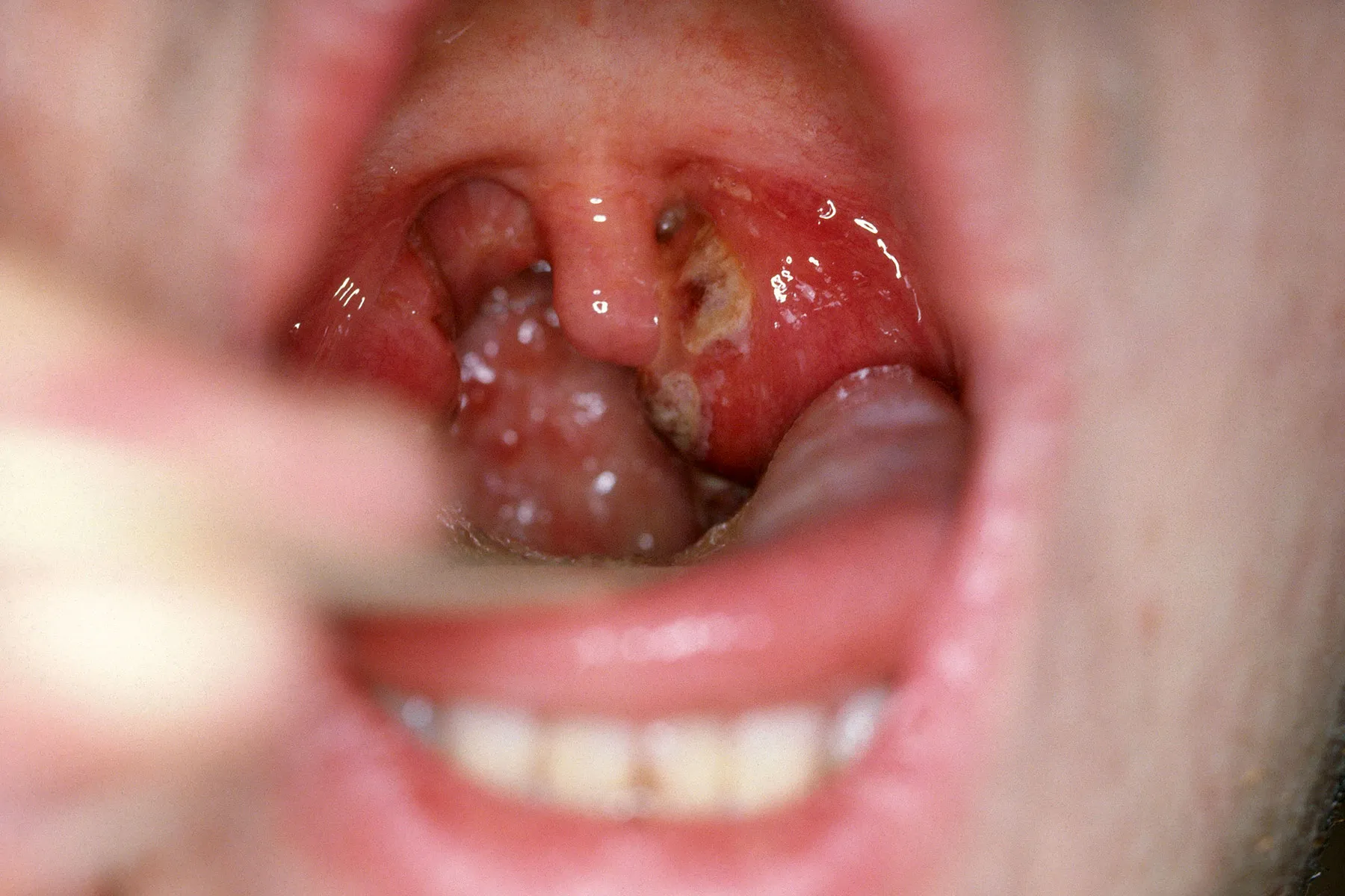 Pictures Of Strep Throat Causes Symptoms And Treatment