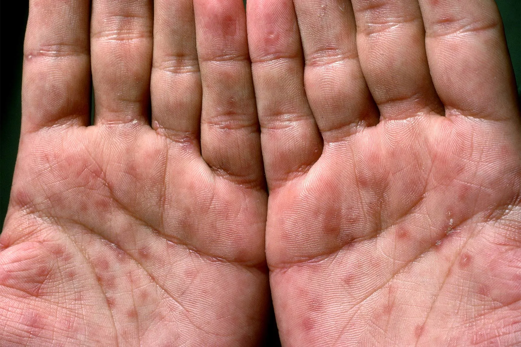 warts on hands hiv