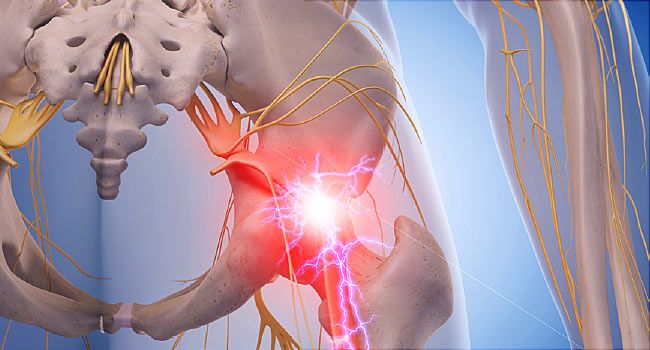 How to Ease Sciatic Nerve Pain