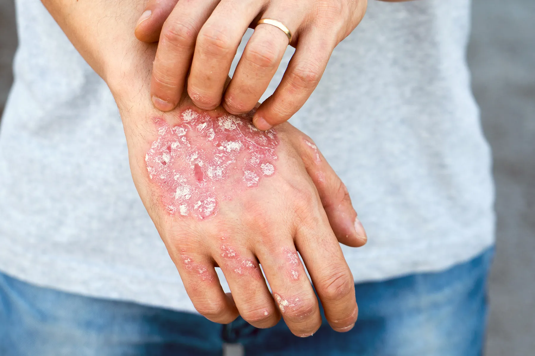 psoriasis worse after pregnancy