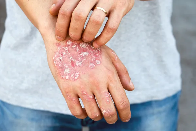 Moderate to Severe Psoriasis and Your Health