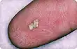 Kidney stone on fingertip 