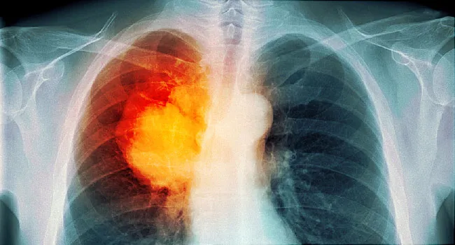 aggressive cancer in lungs