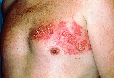 shingles blisters on chest