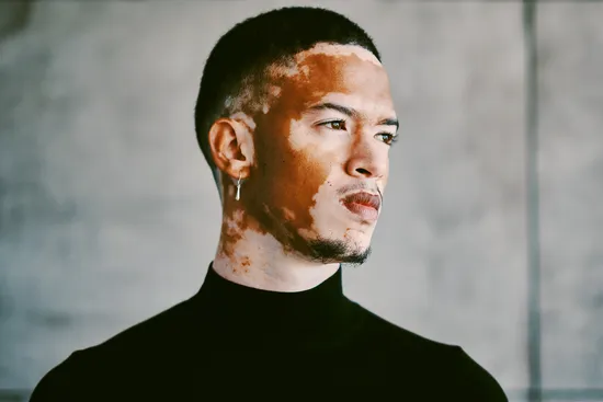 photo of man with vitiligo