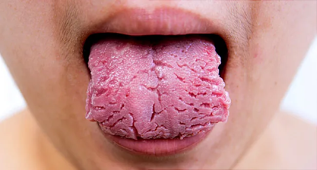 Tongue Problems